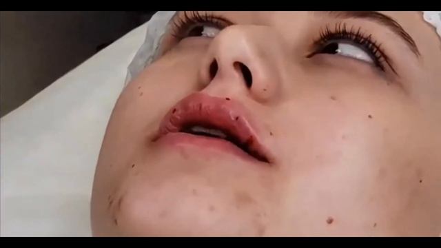 HYALAX Filler. Lip Correction