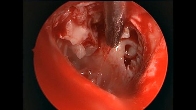 Dr. Rzayev Rufat. Neotympanic Membrane Lateralization – Endoscopic Exploratory Tympanotomy смотреть онлайн