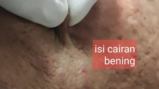 Kista? Laser Saja! | Hidrocystoma | Natasha Skin Clinic Centre смотреть онлайн