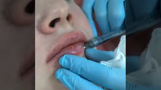 Коррекция и увеличение губ гиалуроновой кислотой смотреть онлайн