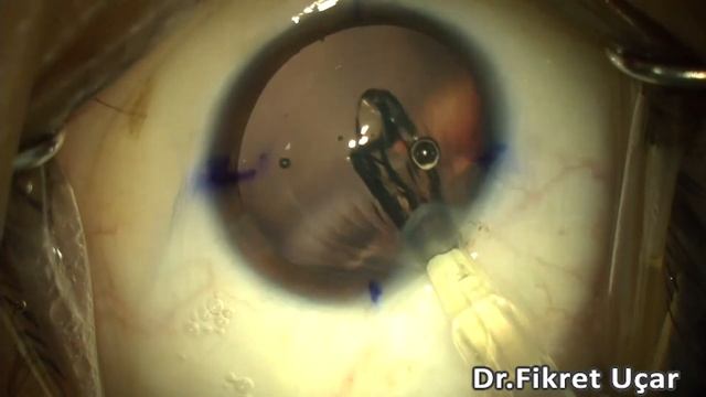 Tecnis SYNERGY Toric IOL Implantation смотреть онлайн