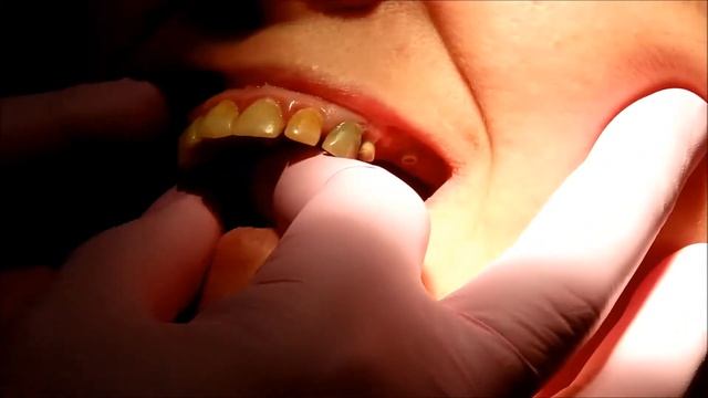 Georgi Pataraya PEEK implantation Часть 7 смотреть онлайн