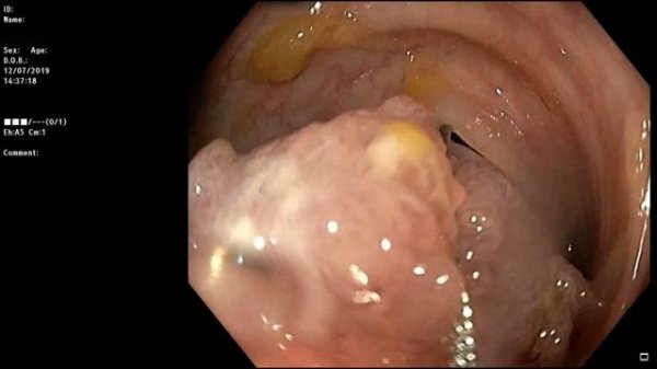 Endoscopic endoloop-assisted polypectomy