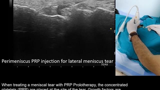 Ultrasound-guided platelet rich plasma (PRP) injection for meniscus tear, by Prof Murat Karkucak MD смотреть онлайн