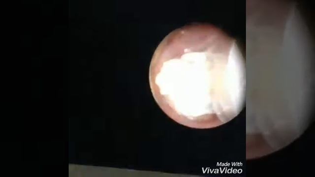 Foreignbody Bronchus - Dr. Mundra смотреть онлайн