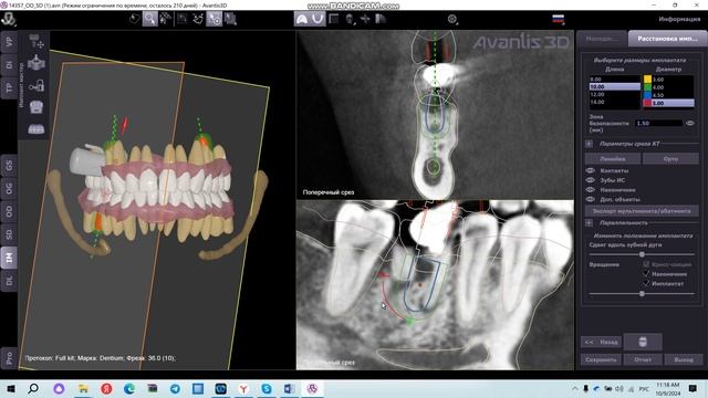 Расстановка имплантатов