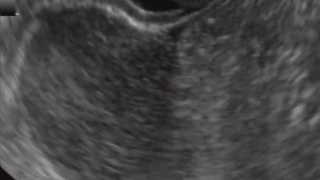 GIST (Tumori Stromali Gastrointestinali): ruolo dell'ecoendoscopia (EUS) смотреть онлайн