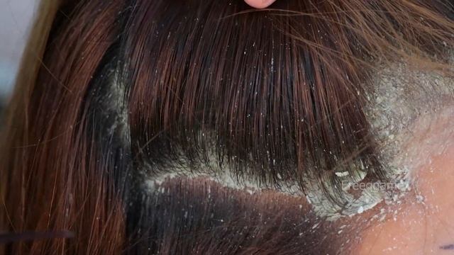 Itchy Dry Scalp!! Dandruff Removing Huge Flakes Satisfying # смотреть онлайн