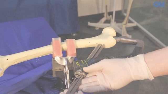 ОСТЕОМЕД®️ Шеечный и деротационный винт Установка. Проксимальный бедренный Y - штифт. смотреть онлайн
