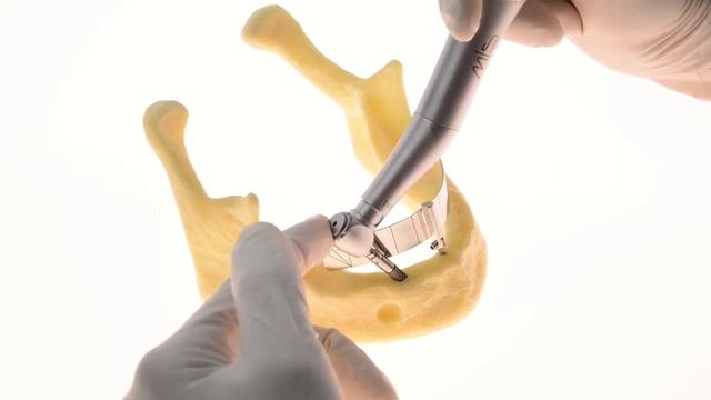 How to Perform MIS MULTIFIX Procedure смотреть онлайн