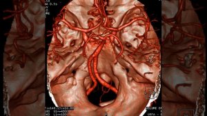 Ангиография сосудов головного мозга