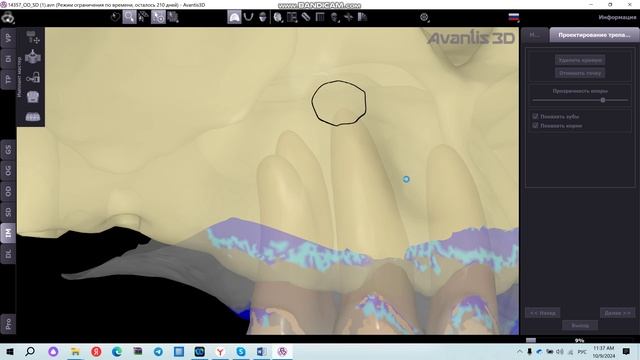 Проектирование трепанационного шаблона