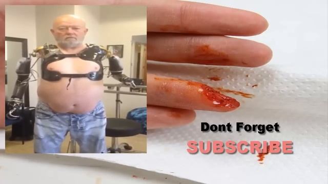 Arm Amputee | Amazing Video Arm Prosthetics(Bionic Arm) смотреть онлайн