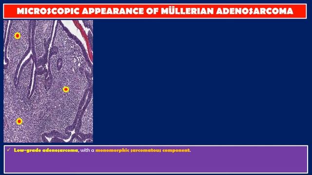 MIXED MÜLLERIAN TUMORS OF THE UTERUS.   BY Dr  WAFAEY BADAWY