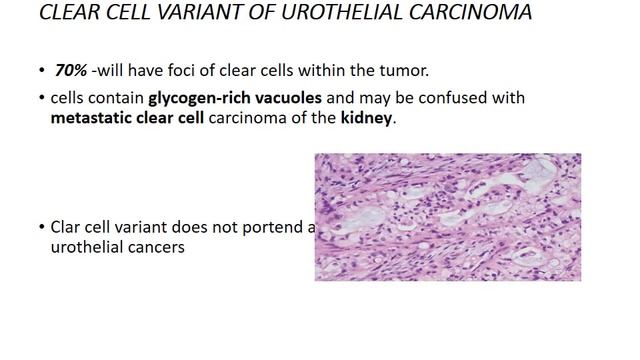 CA urinary bladder stage and basic pathology смотреть онлайн