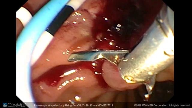 Dr. Harshit Khara - Endoscopic Ampullectomy Using DuraClip® - CONMED Surgical Technique смотреть онлайн