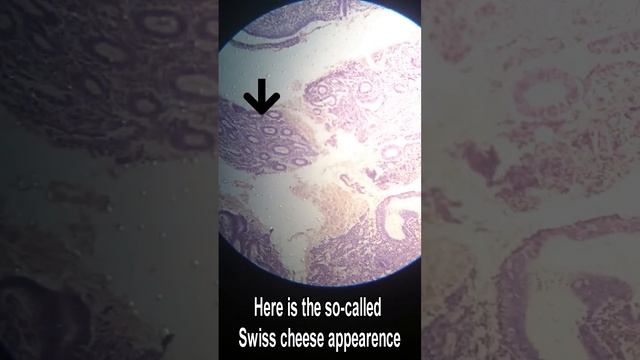 Endometrial Hyperplasia Histopathology смотреть онлайн