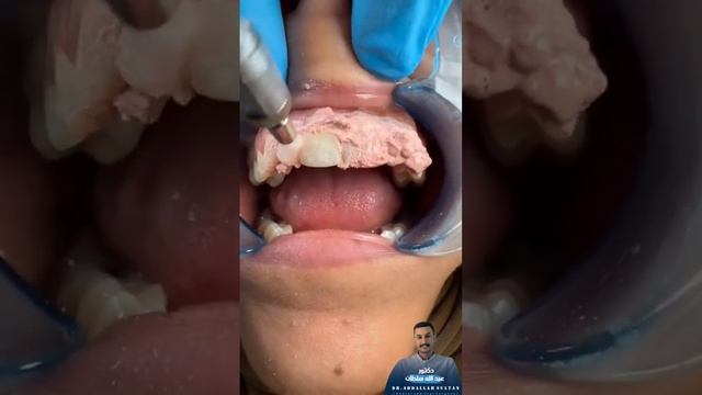 تنظيف الجير وتلميع الأسنان ||Dental scaling #dr_abdullah_sultan_dentist #dentist смотреть онлайн