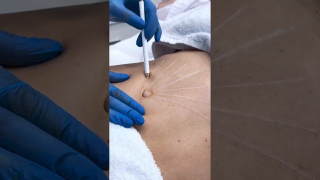 Запись на процедуру по ссылке в шапке профиля #косметология смотреть онлайн