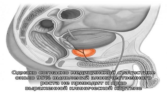 Факторы, провоцирующие развитие злокачественного рака предстательной железы смотреть онлайн