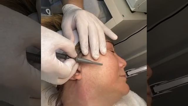 Can broken capillaries heal? @estheticsnyc смотреть онлайн