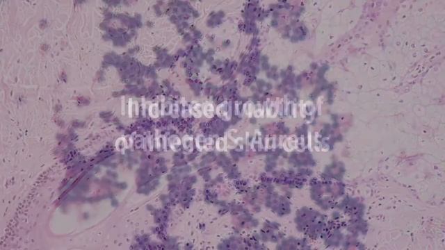 Lactobacillus Rhamnosus GG Protects Skin Cells | Probiotic, Skin, Acne, Psoriasis, Eczema