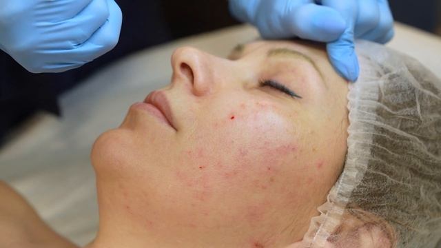 Практическая часть вебинара по акне с комментариями #вебинар #косметология #лечениеакне смотреть онлайн