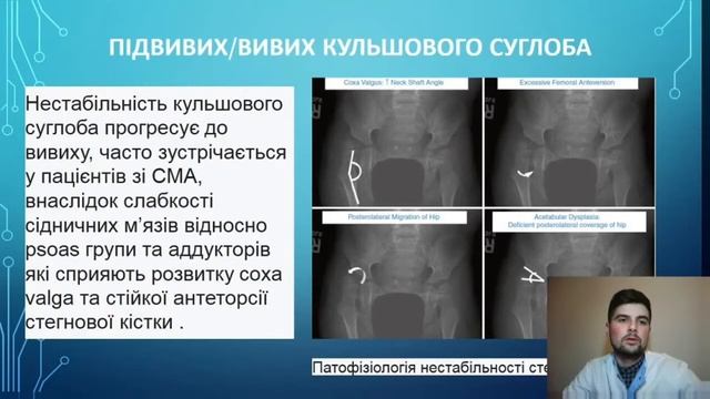 Стратегія лікування ортопедичних проявів при спінальній м’язовій атрофії смотреть онлайн
