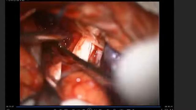 ADENOMA HIPOFISIARIO | CIRUGIA EXPLICACIÓN смотреть онлайн