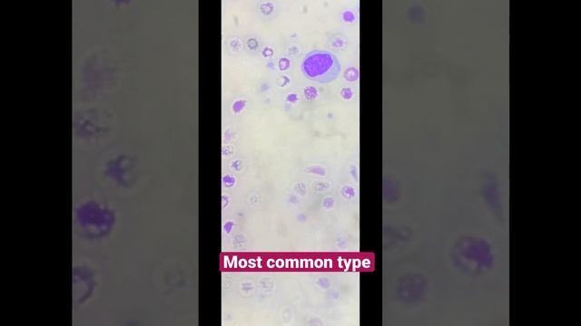 Reactive lymphocyte type II(100x view) #Pathology смотреть онлайн