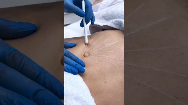 Запись по ссылке в шапке профиля #косметология смотреть онлайн