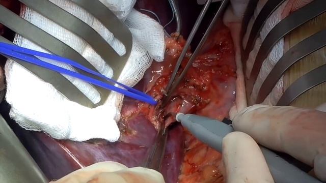 #5 Open Living Donor Right Hepatectomy смотреть онлайн