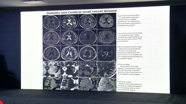 Diabetes and Stroke | Dr Sivaranjan Thandeswaran | MEDTADCON 2022 | Medusane смотреть онлайн