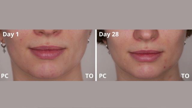 The Ordinary and Paula's Choice Azelaic Acid 10% | 4 Weeks Before and After Pictures | Split Face смотреть онлайн