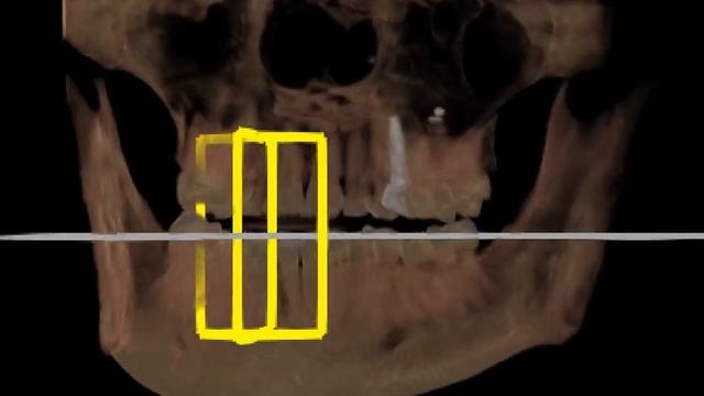 Дентальная компьютерная томография. 3D изображение зубочелюстной области с выделенным сегментом. смотреть онлайн