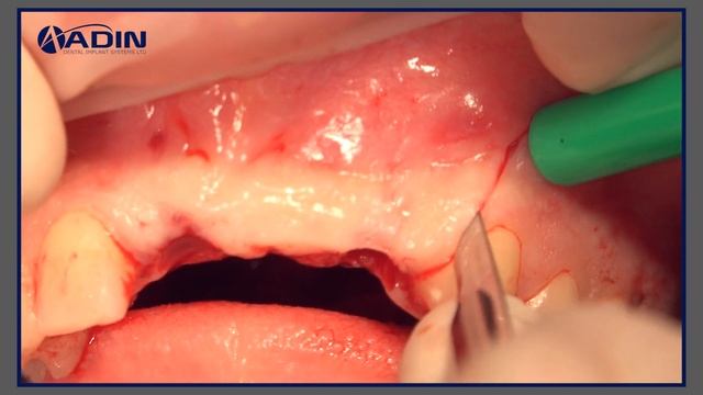 Use of Lamina (OsteoBiol) in the Anterior Maxilla Atrophy смотреть онлайн