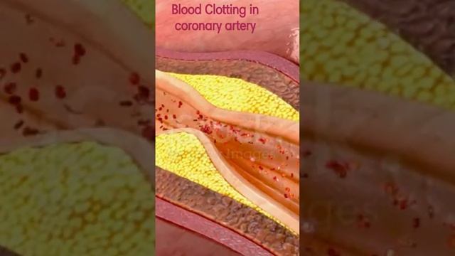 Blood clotting in coronary artery смотреть онлайн