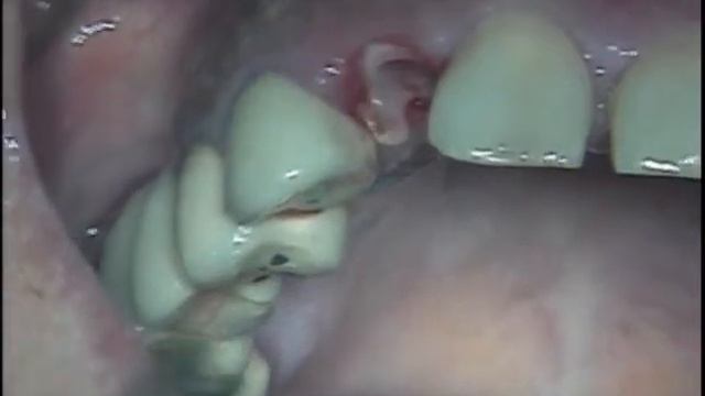 ROOT MEMBRANE TECHNIQUE FOR IMMEDIATE IMPLANT RESTORATION IN POSITION OF A FRACTURED INCISOR OF UPP смотреть онлайн