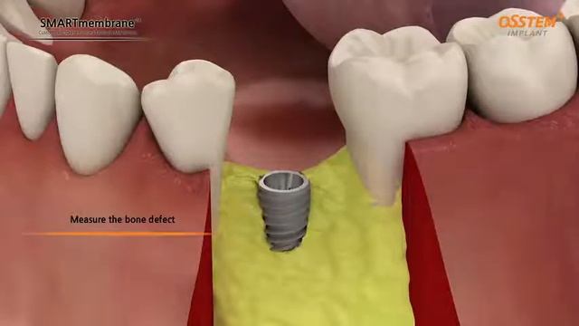 OssBuilder SmartBuilder Osstem Implant смотреть онлайн