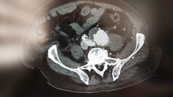 Артерио-венозная фистула