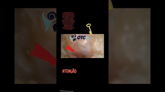 Perfuração do tímpano com chave 🔑 / eardrum drilling with key смотреть онлайн