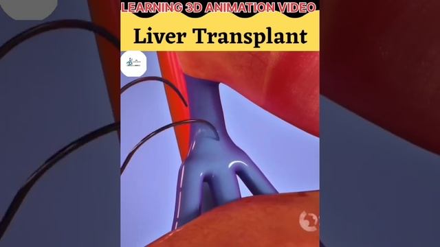 3D ANIMATION LIVER TRANSPLANT смотреть онлайн