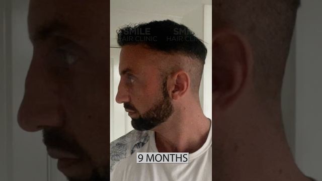 Does Hair Transplant Work? - Here Is A Good Result In 9 Months
