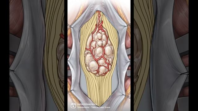 Myxopapillary Ependymoma, A Tumor That Arises From Spinal Cord This One Within The Conus Medullaris