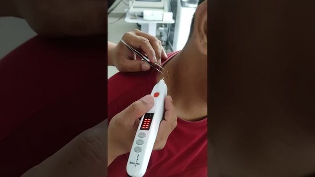 Plasma Pen Beauty Monster. Tutorial cara penggunaan alat Plasma Pen смотреть онлайн
