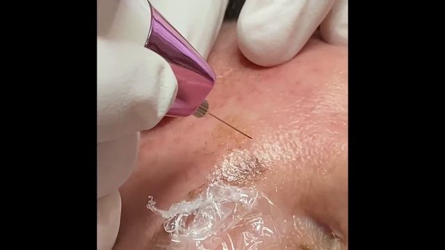 Plasma Pen Skin Tightening at Allure Infinite Beauty смотреть онлайн