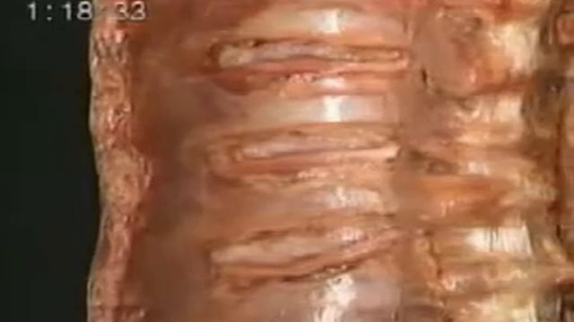 Анатомия видео дарс: Қовурғалараро нерв смотреть онлайн