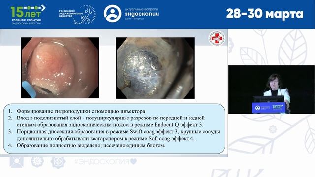 Эндоскопическая диссекция гигантского полипа желудка у ребенка с синдромом Пейтца-Егерса