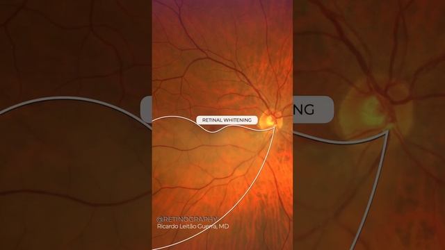 Branch retinal artery occlusion #retina #oftalmo #ophthalmology #oftalmologia #oftalmología #ophta смотреть онлайн