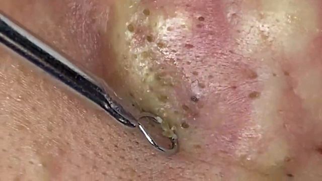 ACNE CLEANING RELAX - KINISH TV #54 смотреть онлайн
